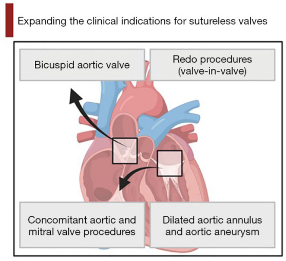 文献速递｜免缝合生物瓣膜技术的新进展及临床应用