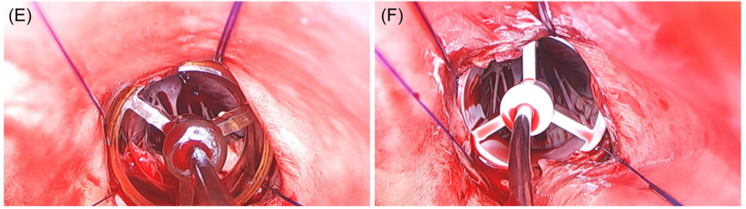 【文献速递】免缝合瓣膜在保留胸骨入路、二叶化主动脉瓣患者中的临床应用