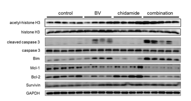 刘澎教授：表观遗传联合方案探索外周T细胞淋巴瘤治疗中的柳暗花明丨病例分享与文献精读