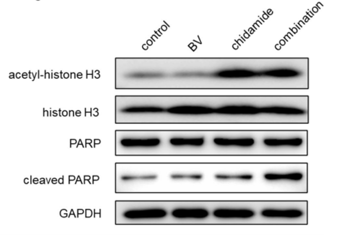刘澎教授：表观遗传联合方案探索外周T细胞淋巴瘤治疗中的柳暗花明丨病例分享与文献精读