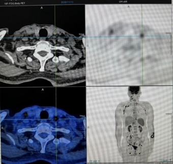 刘澎教授：表观遗传联合方案探索外周T细胞淋巴瘤治疗中的柳暗花明丨病例分享与文献精读
