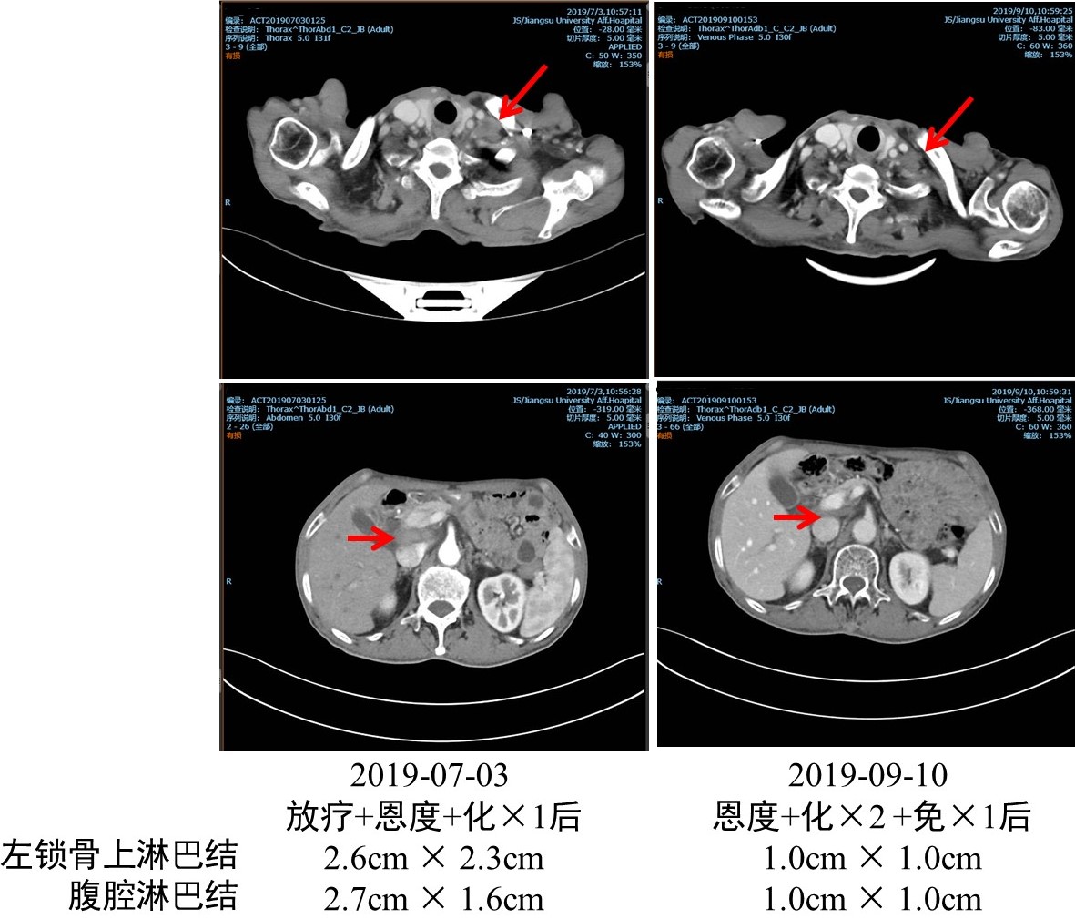 以雷替曲塞为基础的放化疗联合免疫治疗食管癌术后淋巴结转移，5个疗程后达部分缓解4.jpg