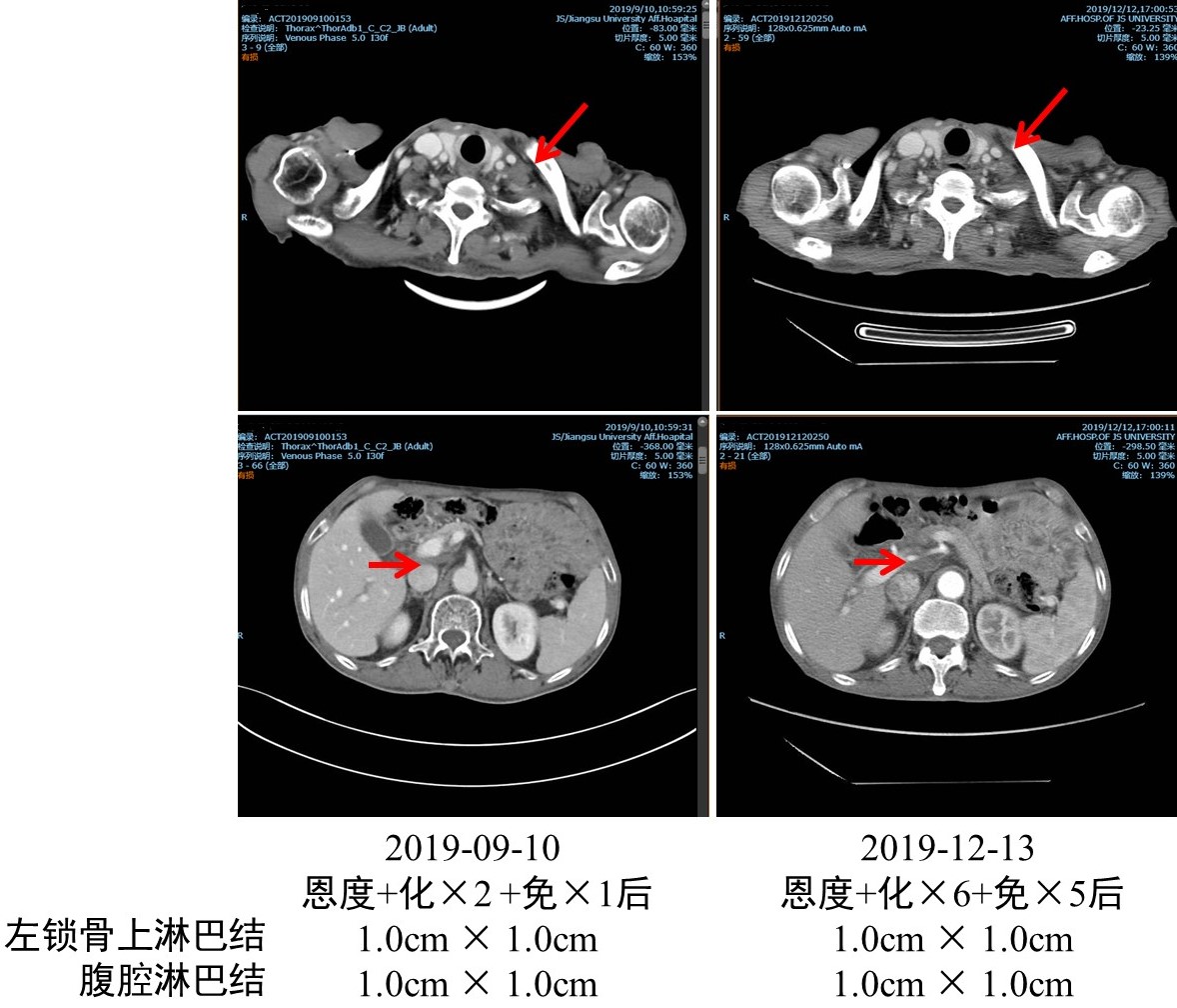 以雷替曲塞为基础的放化疗联合免疫治疗食管癌术后淋巴结转移，5个疗程后达部分缓解5.jpg