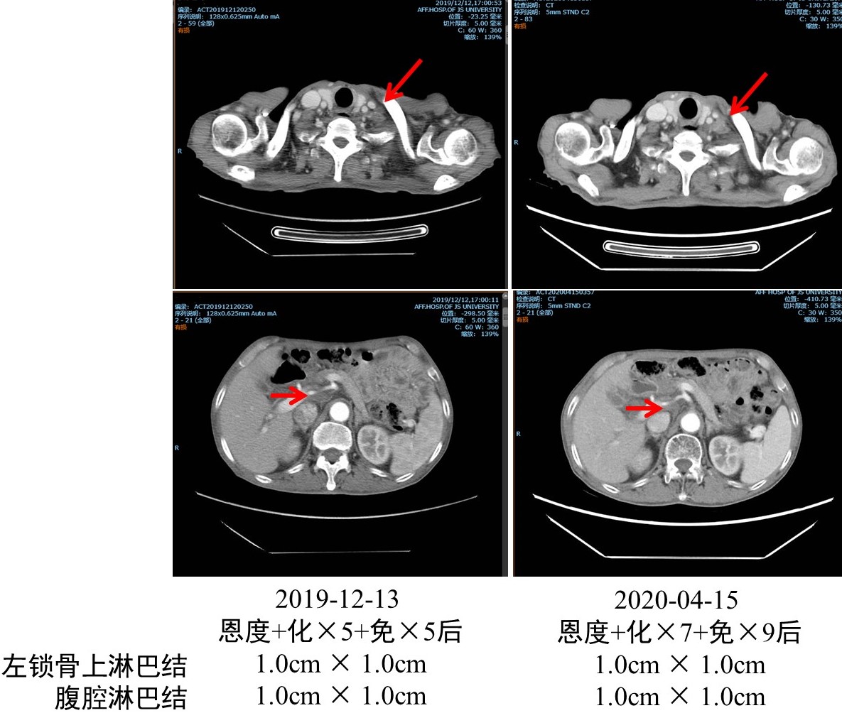 以雷替曲塞为基础的放化疗联合免疫治疗食管癌术后淋巴结转移，5个疗程后达部分缓解6.jpg