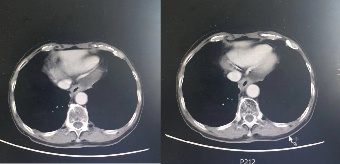 安全耐受，良好依从，方能持续获益——雷替曲塞单药治疗合并严重心脏基础疾病的高龄晚期食管癌病例经验3.png