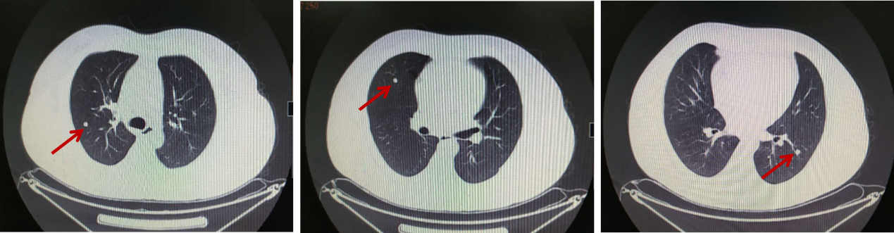 氟尿嘧啶类药物不耐受的多发转移性结肠癌后线治疗何去何从？1.png