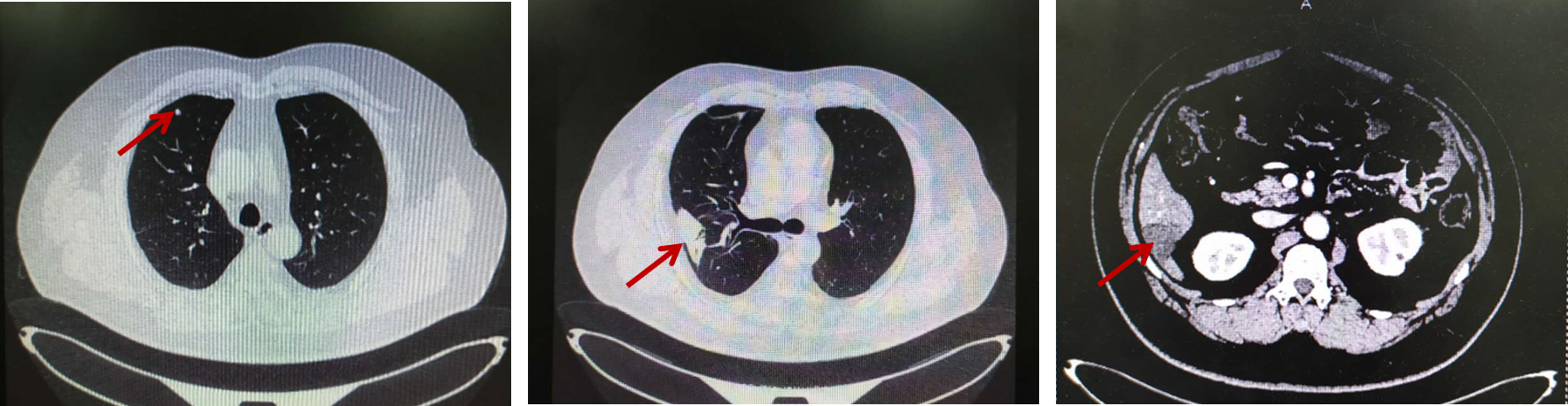 氟尿嘧啶类药物不耐受的多发转移性结肠癌后线治疗何去何从？5.png