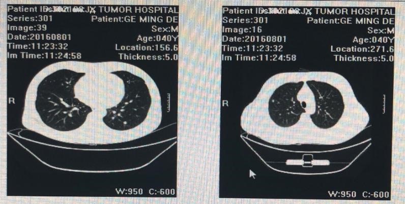 标准化疗方案不耐受的复发转移性直肠癌，该如何制定化疗策略？1.jpg