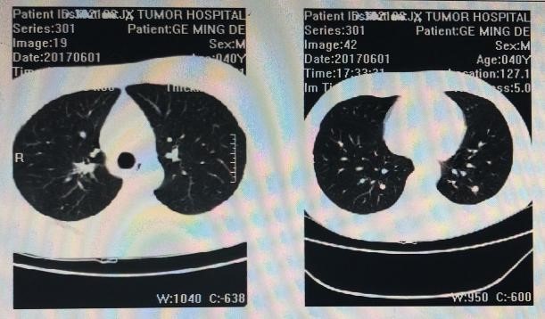 标准化疗方案不耐受的复发转移性直肠癌，该如何制定化疗策略？3.jpg