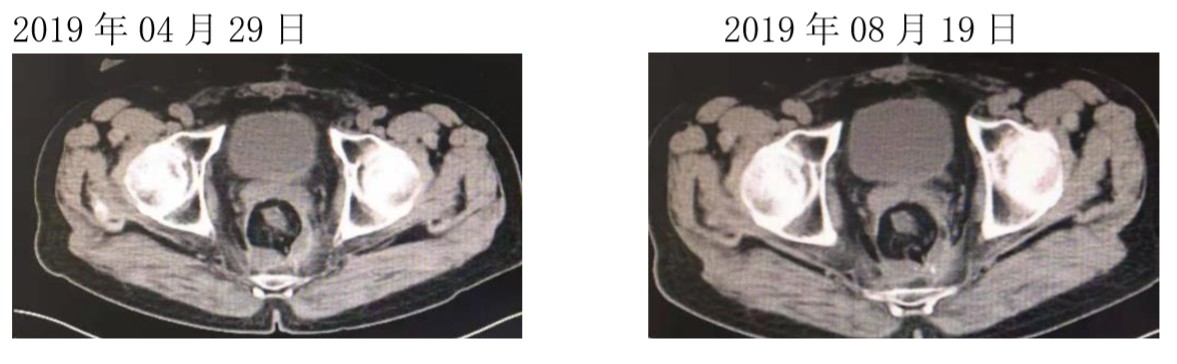 复发转移性结直肠癌患者优选方案7.jpg