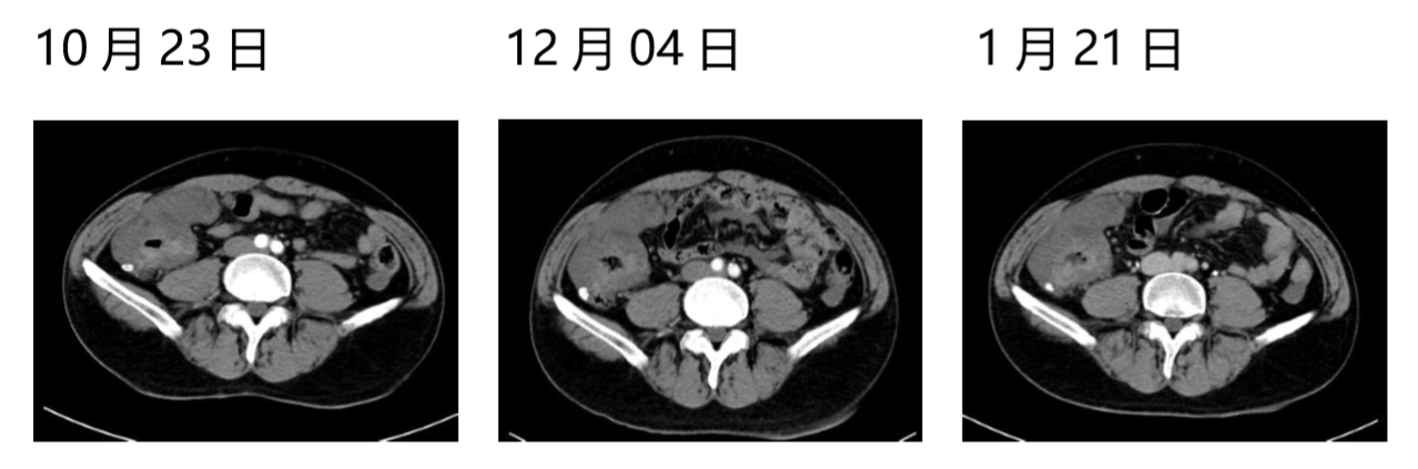 化疗与靶向联合治疗，患者的生存获益5.png