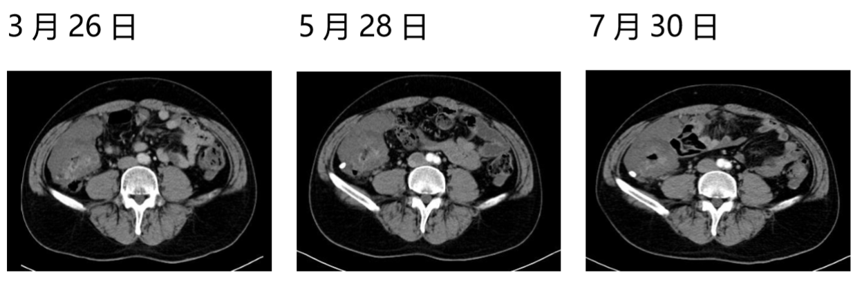 化疗与靶向联合治疗，患者的生存获益6.png