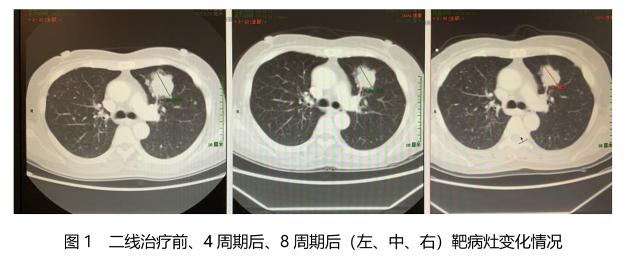 合理选择化疗方案，最大化晚期结肠癌骨转移患者获益1.png