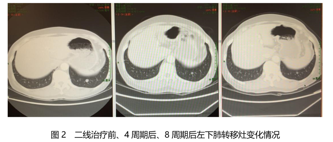 合理选择化疗方案，最大化晚期结肠癌骨转移患者获益2.png