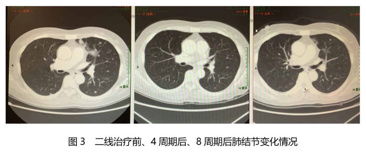 合理选择化疗方案，最大化晚期结肠癌骨转移患者获益3.png