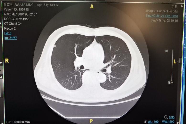 合理选择疗效与安全性并重的治疗方案，为直肠癌术后肝肺转移患者带来更多获益5.jpg