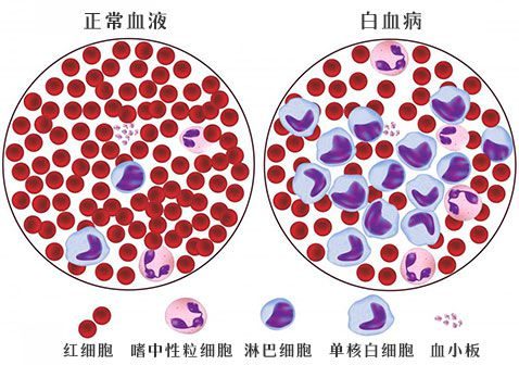 什么白血病—人体造血系统科普篇2.png