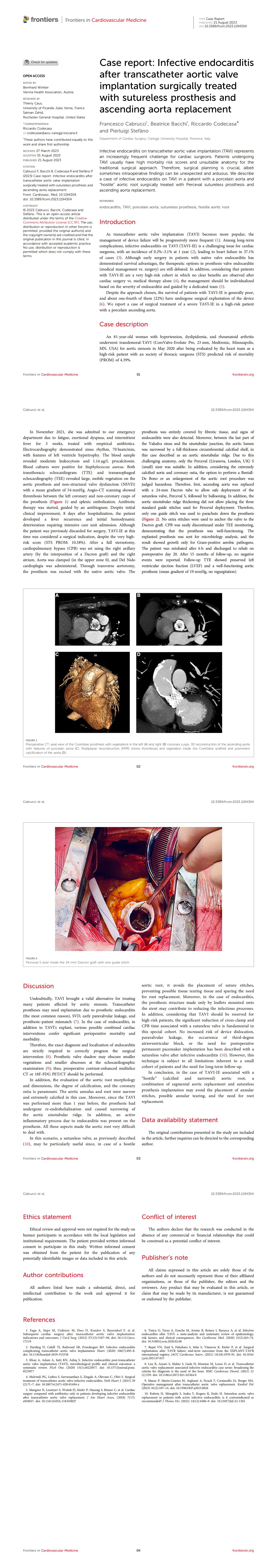 IE after TAVI treated with SUAVR and AAR1_00.jpg